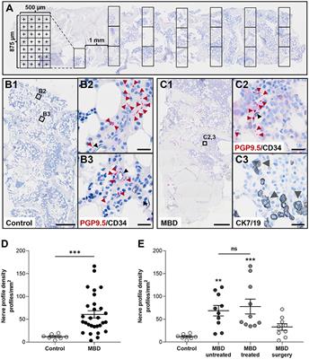 Neuronal Sprouting and Reorganization in Bone Tissue Infiltrated by Human Breast Cancer Cells